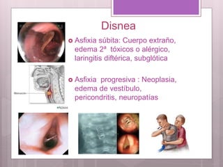 Disnea
 Asfixia súbita: Cuerpo extraño,
edema 2ª tóxicos o alérgico,
laringitis diftérica, subglótica
 Asfixia progresiva : Neoplasia,
edema de vestíbulo,
pericondritis, neuropatías
 