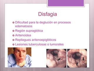 Disfagia
 Dificultad para la deglución en procesos
edematosos
 Región supraglótica
 Aritenoidea
 Repliegues aritenoepiglóticos
 Lesiones tuberculosas o tumorales
 