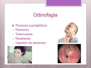 Odinofagia
 Procesos supraglóticos
- Flemones
- Tuberculosis
- Neoplasias
- Ingestión de alimentos
 