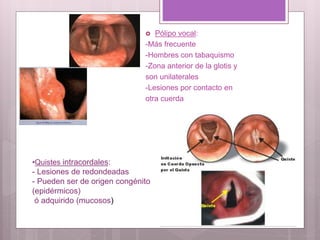  Pólipo vocal:
-Más frecuente
-Hombres con tabaquismo
-Zona anterior de la glotis y
son unilaterales
-Lesiones por contacto en
otra cuerda
•Quistes intracordales:
- Lesiones de redondeadas
- Pueden ser de origen congénito
(epidérmicos)
ó adquirido (mucosos)
 
