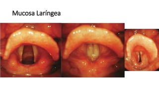 Mucosa Laríngea
 