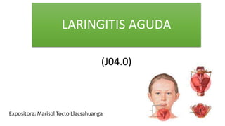 LARINGITIS AGUDA
(J04.0)
Expositora: Marisol Tocto Llacsahuanga
 