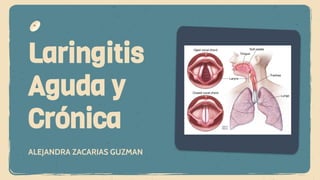 ALEJANDRA ZACARIAS GUZMAN
Laringitis
Aguda y
Crónica
 