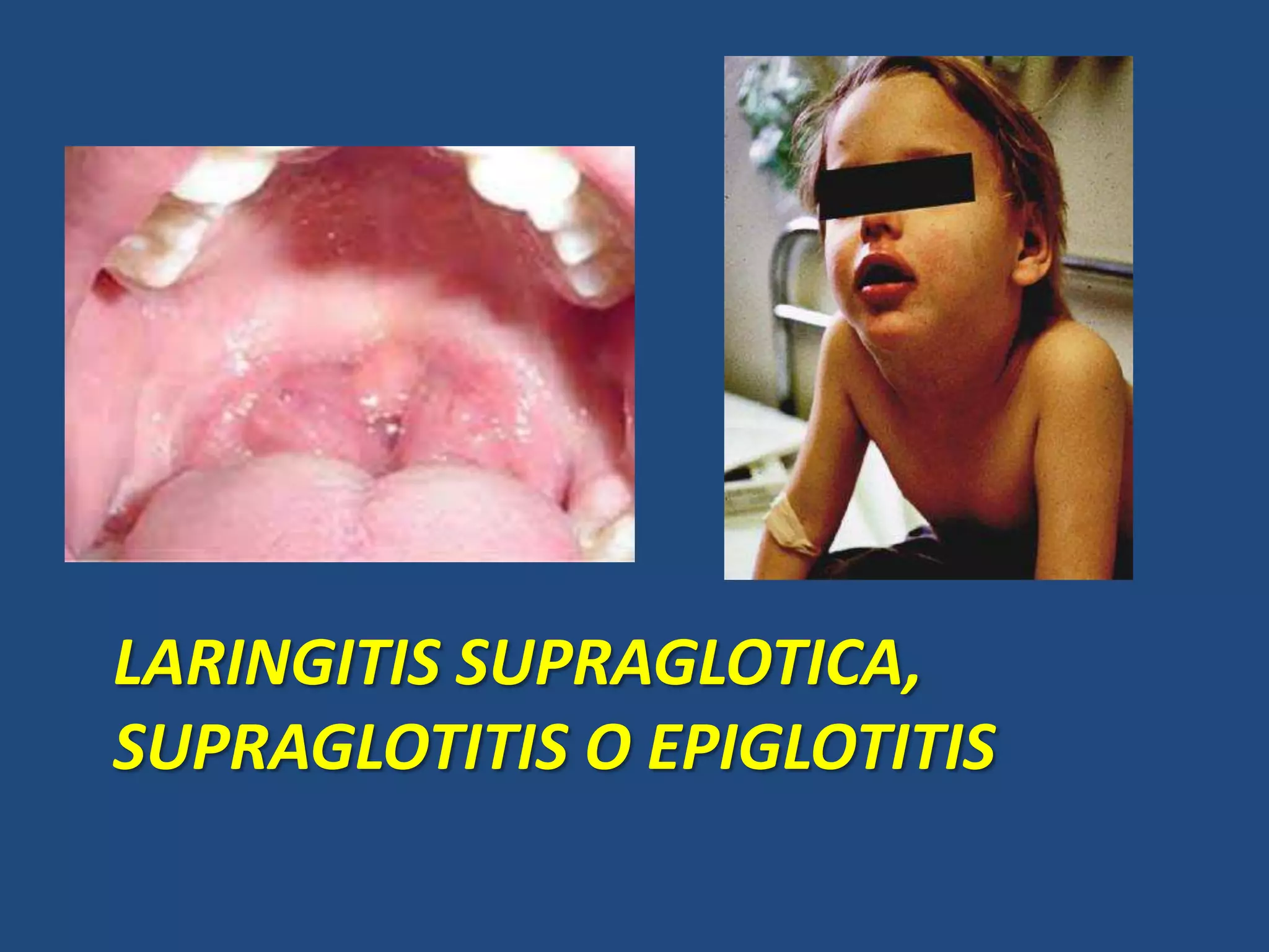 Laringitis supraglotica, glotica e infraglótica | PPT