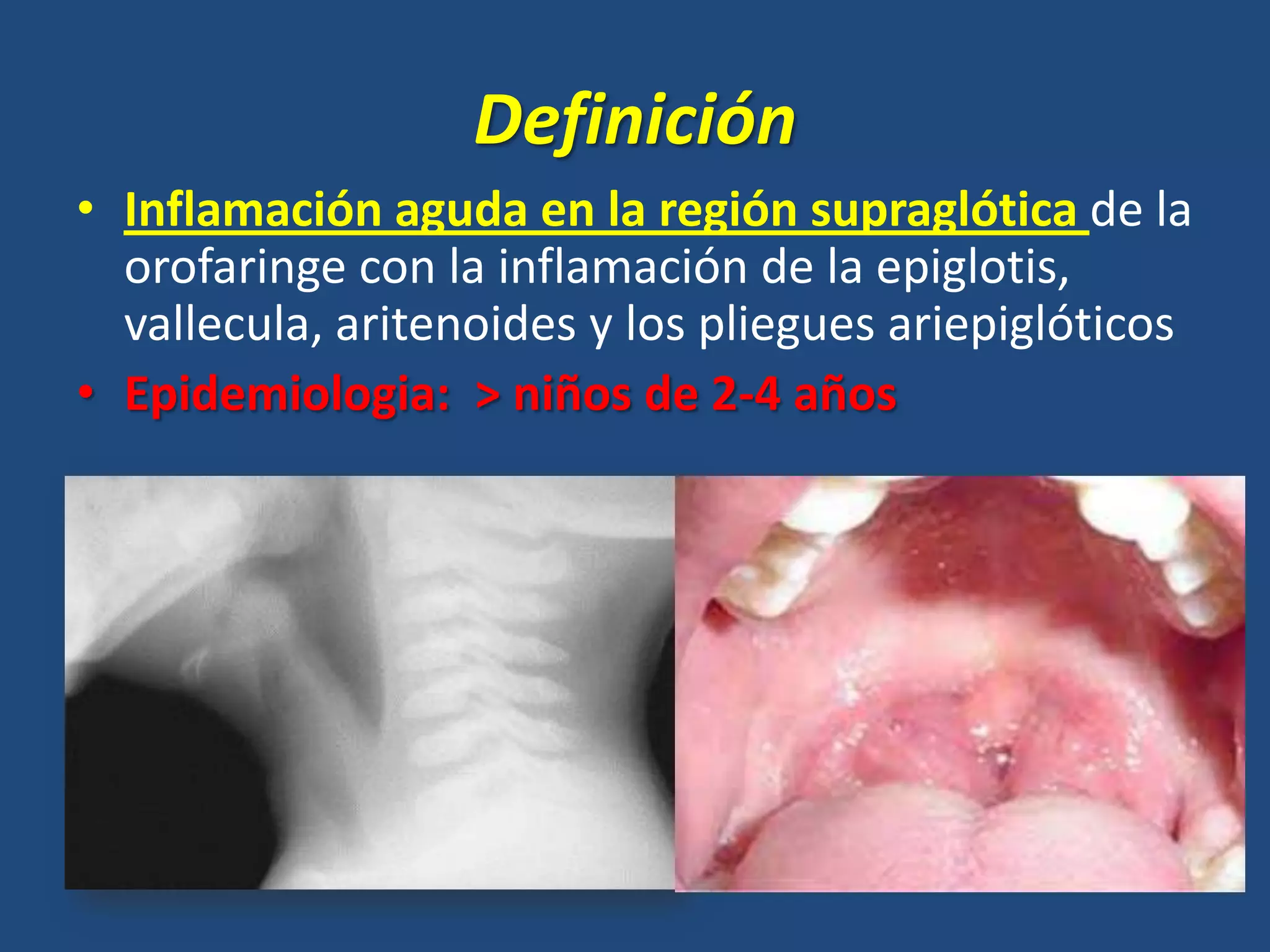 Laringitis supraglotica, glotica e infraglótica | PPT