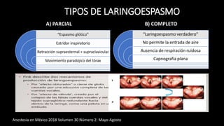 TIPOS DE LARINGOESPASMO
A) PARCIAL
“Espasmo glótico”
Estridor inspiratorio
Retracción supraesternal + supraclavicular
Movimiento paradójico del tórax
B) COMPLETO
“Laringoespasmo verdadero”
No permite la entrada de aire
Ausencia de respiración ruidosa
Capnografía plana
Anestesia en México 2018 Volumen 30 Número 2: Mayo-Agosto
 