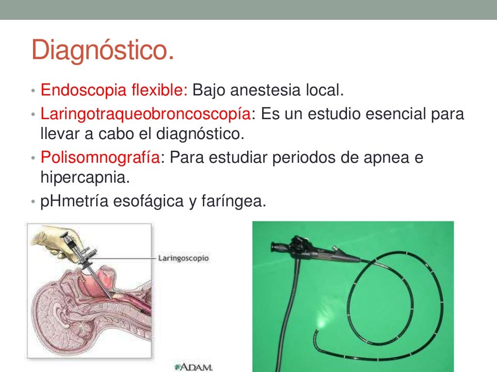 Laringomalacia