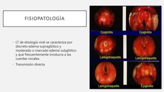 FISIOPATOLOGÍA
• LT de etiología viral se caracteriza por
discreto edema supraglótico y
moderado o marcado edema subglótico
y que frecuentemente involucra a las
cuerdas vocales.
• Transmisión directa
 