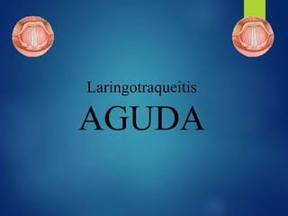 Laringotraqueitis
AGUDA
 