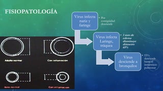 FISIOPATOLOGÍA
Virus infecta
nariz y
faringe
• Por
contigüidad
desciende
Virus infecta
Laringe,
tráquea
• 1 mm de
edema
disminuye
diámetro
65%
Virus
desciende a
bronquilos
• 15%
desciende
hasta el
instersticio
pulmonar
 