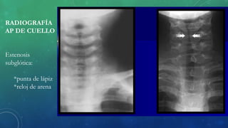 RADIOGRAFÍA
AP DE CUELLO
Estenosis
subglótica:
*punta de lápiz
*reloj de arena
 