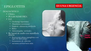 EPIGLOTITIS
DIAGNÓSTICO
• Clínico
• PULSIOXIMETRÍA
• E.F.
• Orofaringe hiperémica
• Abundantes secreciones
• Epiglotis edematosa, enrojecida
• Babeo
• Adenomegalias cervicales.
• Rx lateral de cuello con mandíbula
abierta
• Protruyente edema supraglótico con
signo de dedo pulgar
• borramiento de valléculas
• curvatura cervical hacia atrás.
ES UNA URGENCIA
 