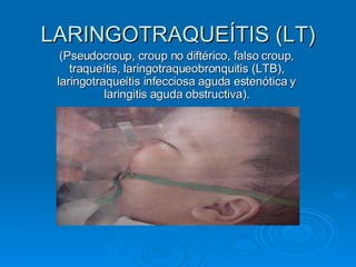 LARINGOTRAQUEÍTIS (LT) (Pseudocroup, croup no diftérico, falso croup, traqueítis, laringotraqueobronquitis (LTB), laringotraqueítis infecciosa aguda estenótica y laringitis aguda obstructiva). 