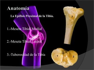 La Epífisis Proximal de la Tibia.
1.-Meseta Tibial Medial
2.-Meseta Tibial Lateral
3.-Tuberosidad de la Tibia 1 2
3
 