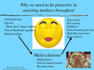Why we need to be proactive in
assisting mothers breastfeed
Ankyloglossia
Lip-ties
“Sling shot” ﬁnger habits
Non-orthodontic paciﬁers
Bottle-feeding
Malocclusions
High palates
Narrow dental arches
Receded chins
Sleep apnea
Bed wetting
ADHD,etc
Noisy breathing,snoring
High Blood pressure
Heart disease
Brian Palmer December 27,. 2011
The evolution of malocclusion and sleep apnea
 