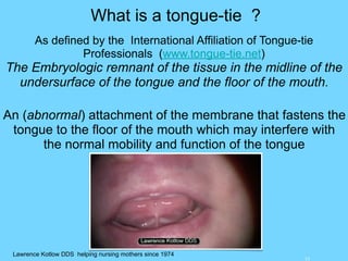 15
What is a tongue-tie ?
Lawrence Kotlow DDS helping nursing mothers since 1974
As defined by the International Affiliation of Tongue-tie
Professionals (www.tongue-tie.net)
The Embryologic remnant of the tissue in the midline of the
undersurface of the tongue and the floor of the mouth.
An (abnormal) attachment of the membrane that fastens the
tongue to the floor of the mouth which may interfere with
the normal mobility and function of the tongue
 