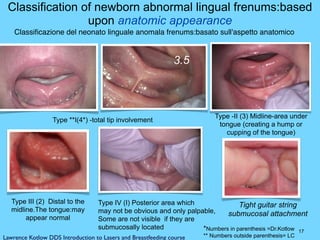 17
Classification of newborn abnormal lingual frenums:based
upon anatomic appearance
Type **I(4*) -total tip involvement
Type III (2) Distal to the
midline.The tongue:may
appear normal
Type -II (3) Midline-area under
tongue (creating a hump or
cupping of the tongue)
Type IV (I) Posterior area which
may not be obvious and only palpable,
Some are not visible if they are
submucosally located *Numbers in parenthesis =Dr.Kotlow
** Numbers outside parenthesis= LCLawrence Kotlow DDS Introduction to Lasers and Breastfeeding course
Tight guitar string
submucosal attachment
3.5
Classiﬁcazione del neonato linguale anomala frenums:basato sull'aspetto anatomico
 