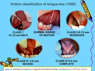 NORMAL RANGE
OF MOTION
CLASS 1
12-16 mm MILD
CLASS II 8-12 mm
MODERATE
CLASS III 4-8 mm
SEVERE
Kotlow classification of tongue-ties (1999)
CLASS IV 0-4 mm
COMPLETE 19
 