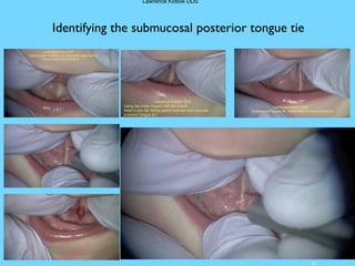 23
Identifying the submucosal posterior tongue tie
Lawrence Kotlow DDS
 