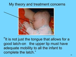24
“It is not just the tongue that allows for a
good latch-on the upper lip must have
adequate mobility to all the infant to
complete the latch.”
My theory and treatment concerns
 