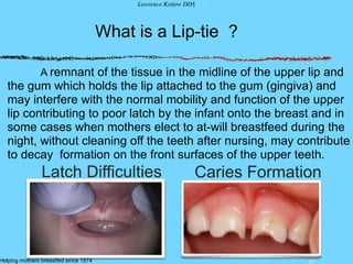 25
What is a Lip-tie ?
A remnant of the tissue in the midline of the upper lip and
the gum which holds the lip attached to the gum (gingiva) and
may interfere with the normal mobility and function of the upper
lip contributing to poor latch by the infant onto the breast and in
some cases when mothers elect to at-will breastfeed during the
night, without cleaning off the teeth after nursing, may contribute
to decay formation on the front surfaces of the upper teeth.
Lawrence Kotlow DDS
Helping mothers breastfed since 1974
Latch Difficulties Caries Formation
 