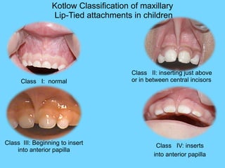 Class IV: inserts
into anterior papilla
Class III: Beginning to insert
into anterior papilla
Class II: inserting just above
or in between central incisorsClass I: normal
Kotlow Classification of maxillary
Lip-Tied attachments in children
 