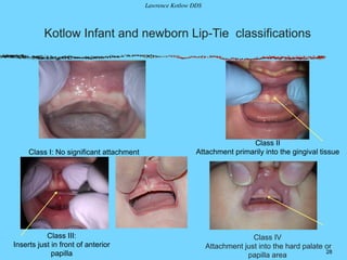 Class IV
Attachment just into the hard palate or
papilla area
28
Kotlow Infant and newborn Lip-Tie classifications
!
Class II
Attachment primarily into the gingival tissue
!
Class III:
Inserts just in front of anterior
papilla
Class I: No significant attachment
Lawrence Kotlow DDS
 