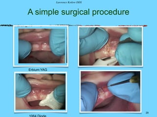 A simple surgical procedure
29
!
Erbium:YAG
!
Lawrence Kotlow DDS
 