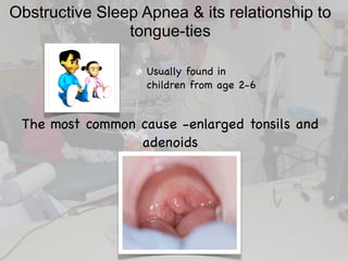 Obstructive Sleep Apnea & its relationship to
tongue-ties
Usually found in
children from age 2-6
The most common cause -enlarged tonsils and
adenoids
 