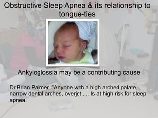 Obstructive Sleep Apnea & its relationship to
tongue-ties
Ankyloglossia may be a contributing cause
Dr.Brian Palmer :”Anyone with a high arched palate,
narrow dental arches, overjet .... Is at high risk for sleep
apnea.
 