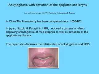 Ankyloglossia with deviation of the epiglottis and larynx
Ann otol rhinol laryngol 100:1991 Mukai et al Ankyloglossia & Dyspnea
In China The Frenectomy has been completed since 1050-BC
In japan, Suzuki & Katagili in 1989, noticed a pattern in infants
displaying ankyloglossia of mild dyspnea as well as deviation of the
epiglottis and larynx
The paper also discusses the relationship of ankyloglossia and SIDS
 