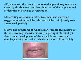 4.Dyspnea was the result of increased upper airway resistance
caised by displacement and less abduction of the larynx as well
as decrease in activities of respiration.
5.Interesting observation : after treatment and increased
oxygen saturation the infant showed thicker hair (usually over
a two week period)
6. Signs and symptoms of hypoxia :dark foreheads, rounding of
the lips, yawning, inactivity, difﬁculty in gazing at objects, light
sleep , underdevelopment of the mandible and temporal
muscles, choking and reﬂux, behavioral abnormalities (adhd).
 