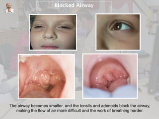 Blocked Airway
40
The airway becomes smaller, and the tonsils and adenoids block the airway,
making the flow of air more difficult and the work of breathing harder.
 