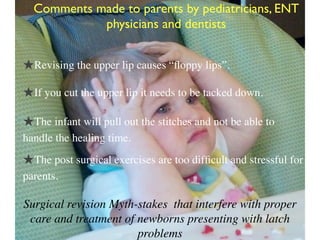 Surgical revision Myth-stakes that interfere with proper
care and treatment of newborns presenting with latch
problems
Comments made to parents by pediatricians, ENT
physicians and dentists
★If you cut the upper lip it needs to be tacked down.
★Revising the upper lip causes “ﬂoppy lips”.
★The infant will pull out the stitches and not be able to
handle the healing time.
★The post surgical exercises are too difﬁcult and stressful for
parents.
 