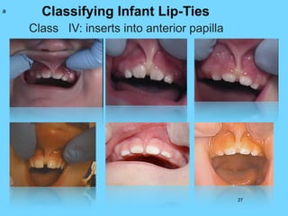 Classifying Infant Lip-Ties
Class IV: inserts into anterior papilla
27
a
 