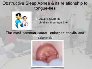 Obstructive Sleep Apnea & its relationship to
tongue-ties
Usually found in
children from age 2-6
The most common cause -en...