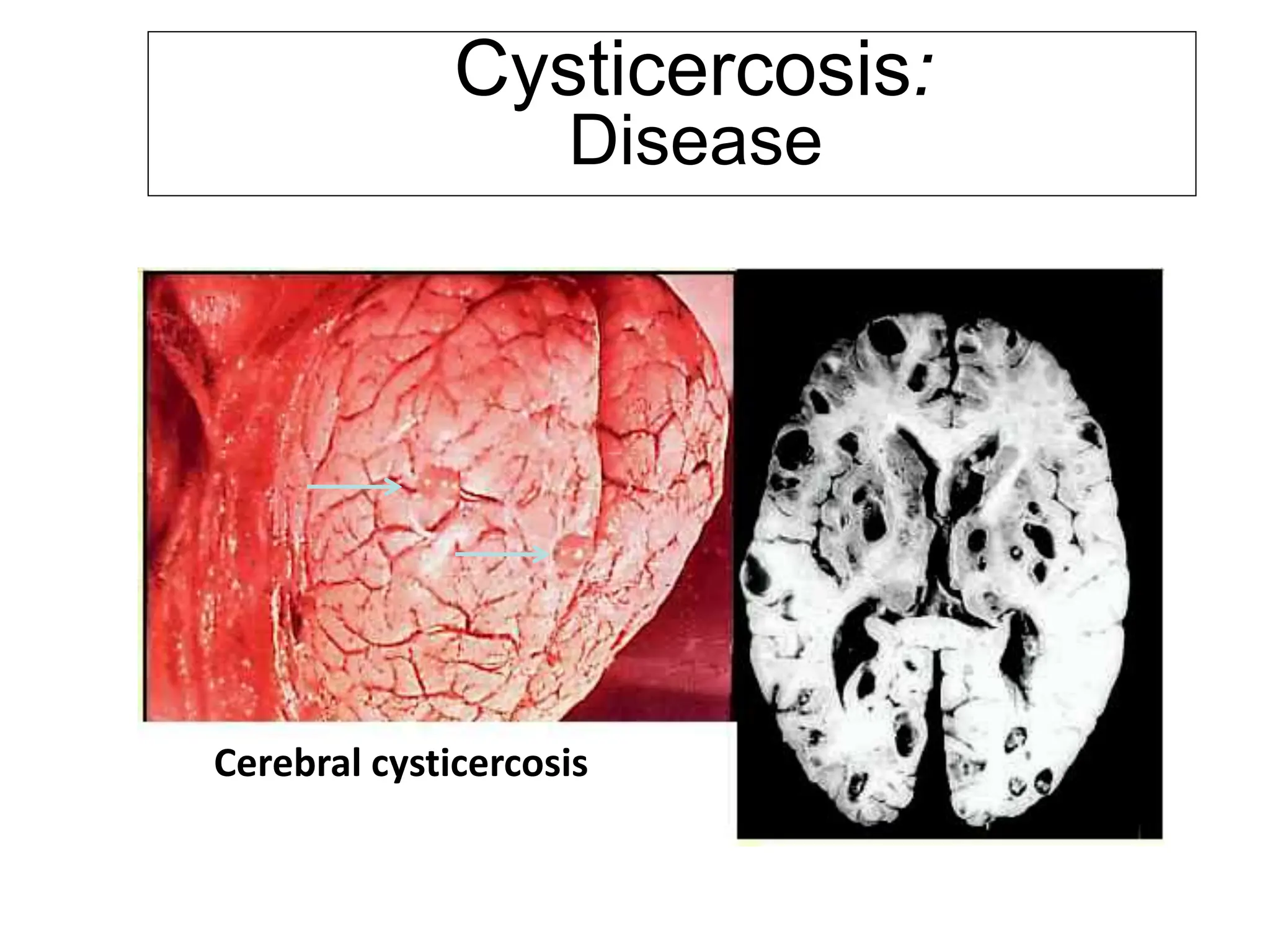 Larval cestodes who cause diseases to humans | PPTX