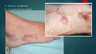  Aguda y pruriginosa
 2 a 8 semanas (6 meses)
 