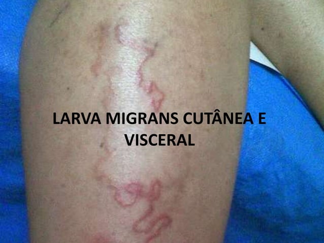 Larva migrans cutânea e visceral | PPTX