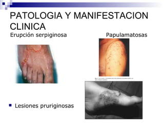 PATOLOGIA Y MANIFESTACION
CLINICA
Erupción serpiginosa        Papulamatosas




   Lesiones pruriginosas
 