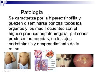 Patologia
Se caracteriza por la hipereosinofilia y
pueden diseminarse por casi todos los
órganos y los mas frecuentes son el
hígado produce hepatomegalia, pulmones
producen neumonías, en los ojos
endoftalmitis y desprendimiento de la
retina.
 