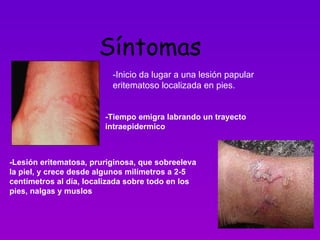 Síntomas  -Inicio da lugar a una lesión papular eritematoso localizada en pies. -Tiempo emigra labrando un trayecto intraepidermico -Lesión eritematosa, pruriginosa, que sobreeleva la piel, y crece desde algunos milímetros a 2-5 centímetros al día, localizada sobre todo en los pies, nalgas y muslos 