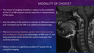 Laryngeal carcinoma Imaging | PPTX