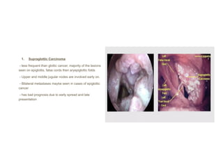 False Fold Overview Comprehensive Overview of Laryngeal and Oropharyngeal Tumors: Diagnosis ...