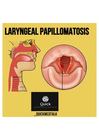Laryngeal papillomatosis .pdf ENT BY QUICKMEDTALK