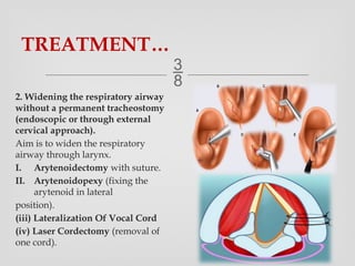 types of laryngeal Paralysis Ear Nose Throat.pptx