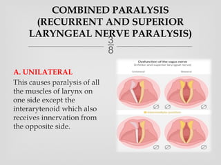 types of laryngeal Paralysis Ear Nose Throat.pptx