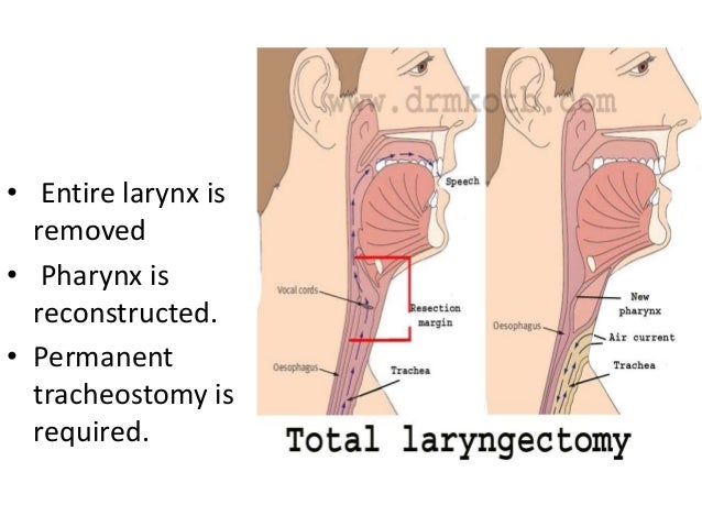 laryngeal surgeries laryngectomy