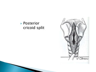  Posterior
cricoid split
 