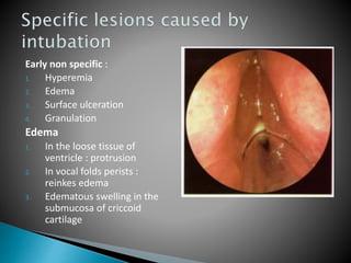 Early non specific :
1. Hyperemia
2. Edema
3. Surface ulceration
4. Granulation
Edema
1. In the loose tissue of
ventricle : protrusion
2. In vocal folds perists :
reinkes edema
3. Edematous swelling in the
submucosa of criccoid
cartilage
 